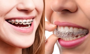 A Comprehensive Guide to Dental Aligners: Choosing, Insuring, and Caring for Your Smile